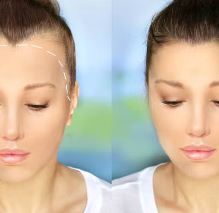 hair-restoration 3